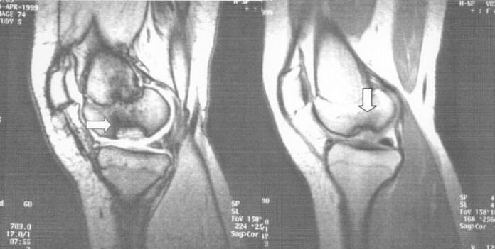 рентгенівський знімок розсікаючого остеохондрозу в колінному суглобі