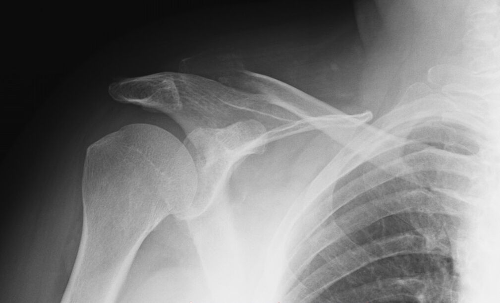 плечовий артроз на рентгенівському знімку