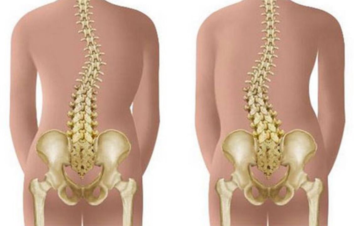 сколіоз як причина болю в спині в області лопаток