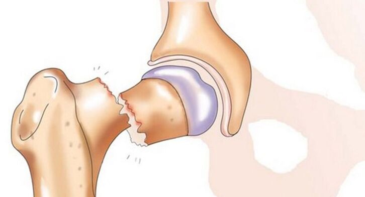 Перелом шийки стегна супроводжується сильним болем у тазостегновому суглобі