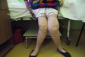 запущений артроз колінного суглоба